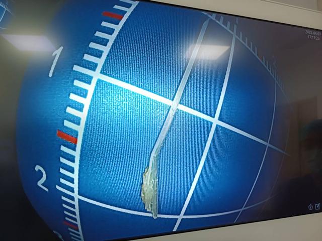 鱼刺卡喉时吞饭团、喝醋有效吗？医生教您正确的处理方法休闲区蓝鸢梦想 - Www.slyday.coM