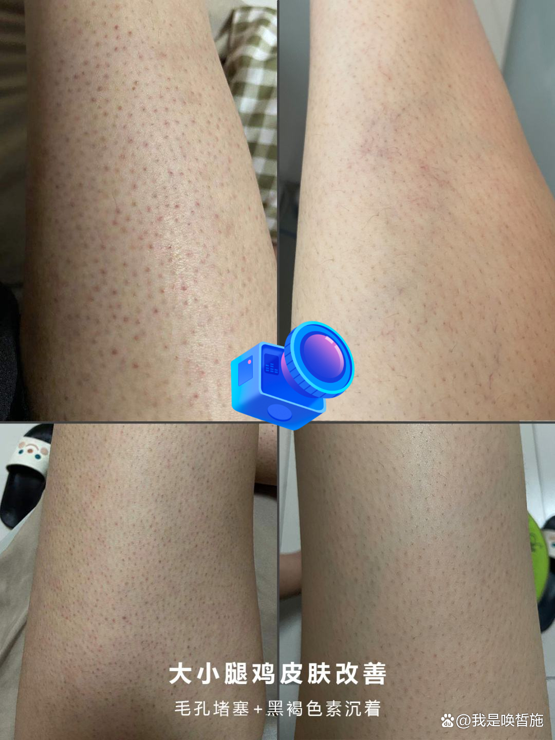 杭州哪家治疗鸡皮肤好(杭州哪家治疗鸡皮肤好的医院) 杭州哪家治疗鸡皮肤好(杭州哪家治疗鸡皮肤好的医院)