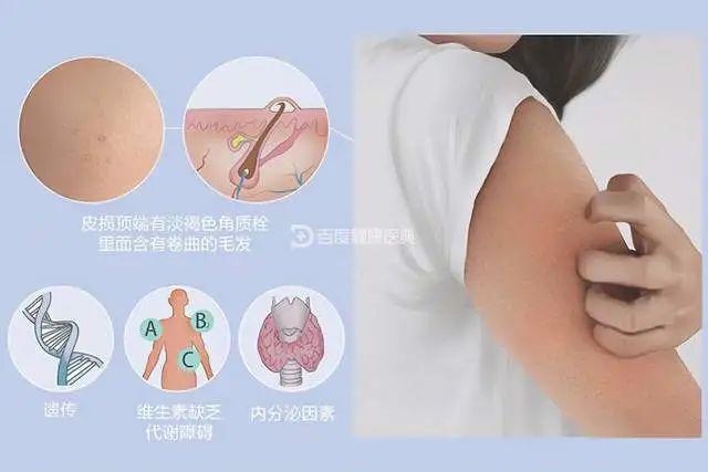 鸡皮肤缺缺乏维生素ad么(维生素ad可以治疗鸡皮肤吗) 鸡皮肤缺缺乏维生素ad么(维生素ad可以治疗鸡皮肤吗)