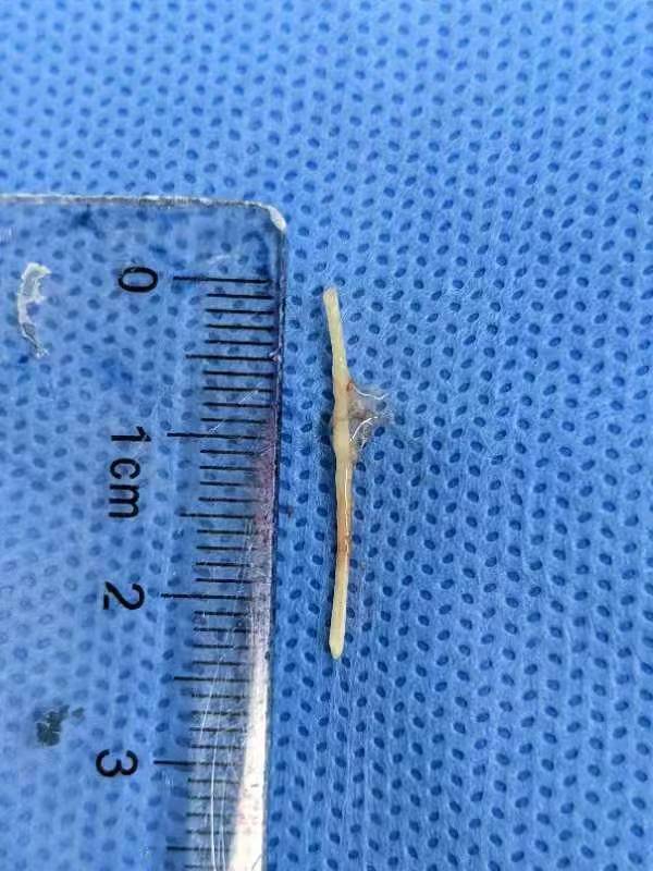 女孩吃饭不慎吞下鸡骨头忍痛五天才就医医生说再不来就危险了