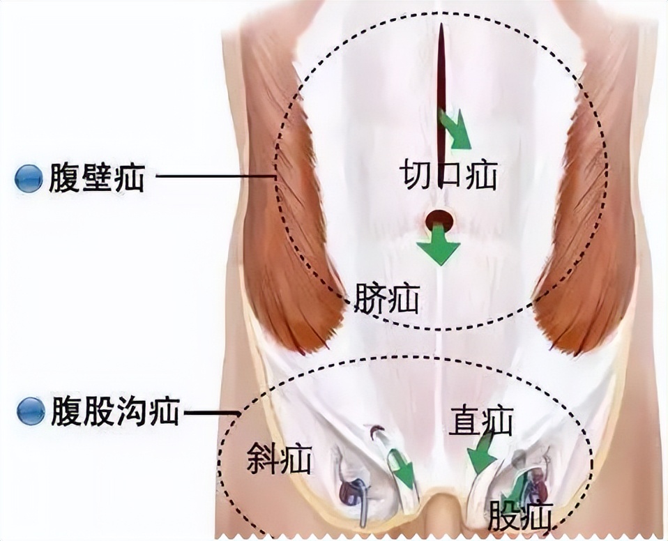 股疝的位置图片 女性图片