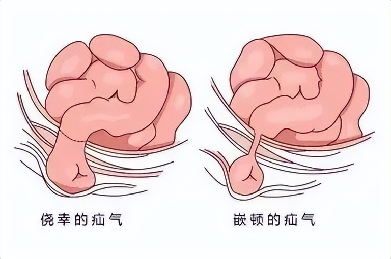 勿因疝小而不为疝气到底是一种什么病