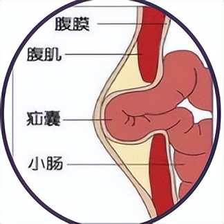 疝气在人群中属于常见病,多发病,俗称"小肠气".