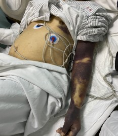 76岁阿伯自行刮痧后送进icu,一查竟和它有关……|刮痧|感冒|血友病