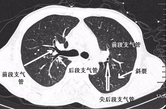支气管CT解剖最佳学习资料!| 图谱+视频解说__财经头条