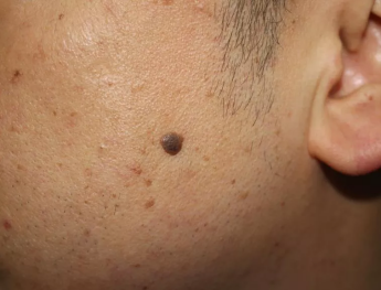 长了这样的“老年斑” 您就要当心啦！