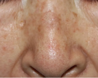 长了这样的“老年斑” 您就要当心啦！