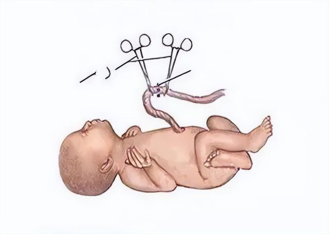 婴儿脐带掉的过程图片图片