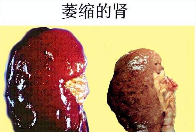 他的肾脏都萎缩了难道感觉不到吗