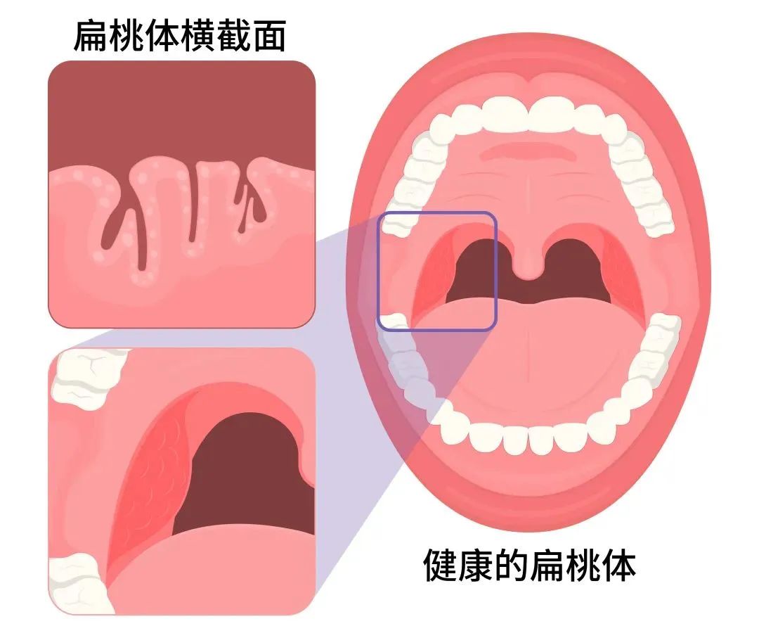 正常儿童口腔喉咙图片图片