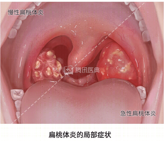 新生儿喉咙长白色颗粒图片