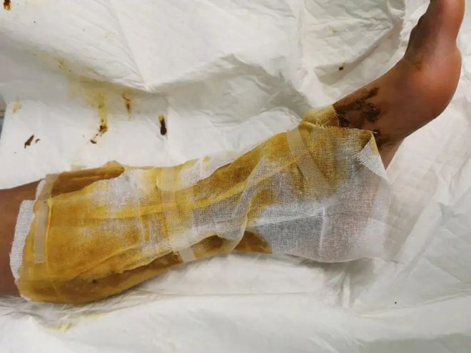 弯腰整理鞋子激怒超级毒蛇女子被蛇咬伤后为蛇拍照救了自己