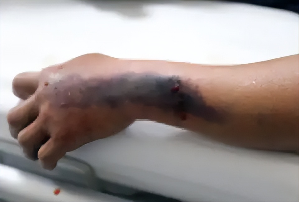 弯腰整理鞋子激怒超级毒蛇！女子被蛇咬伤后，为蛇拍照救了自己休闲区蓝鸢梦想 - Www.slyday.coM