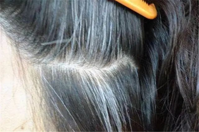 白发增多的人一定要多刮这个地方