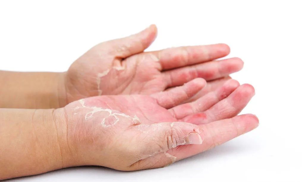 手脱皮最佳治疗方法图片
