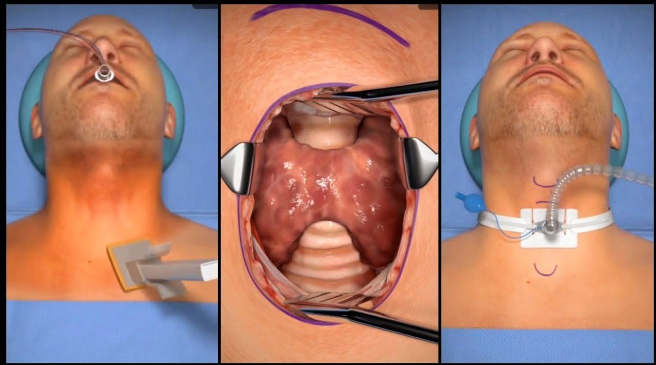 医学视频科普医学动画气管切开术67