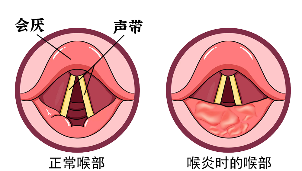 宝宝出现这些症状要小心,严重会窒息|喉炎|喉梗阻|呼吸困难_新浪新闻