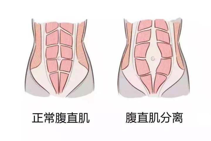 腹直肌分离除了容易导致腰痛,疲劳外,还会导致腹腔脏器移位,出现漏尿