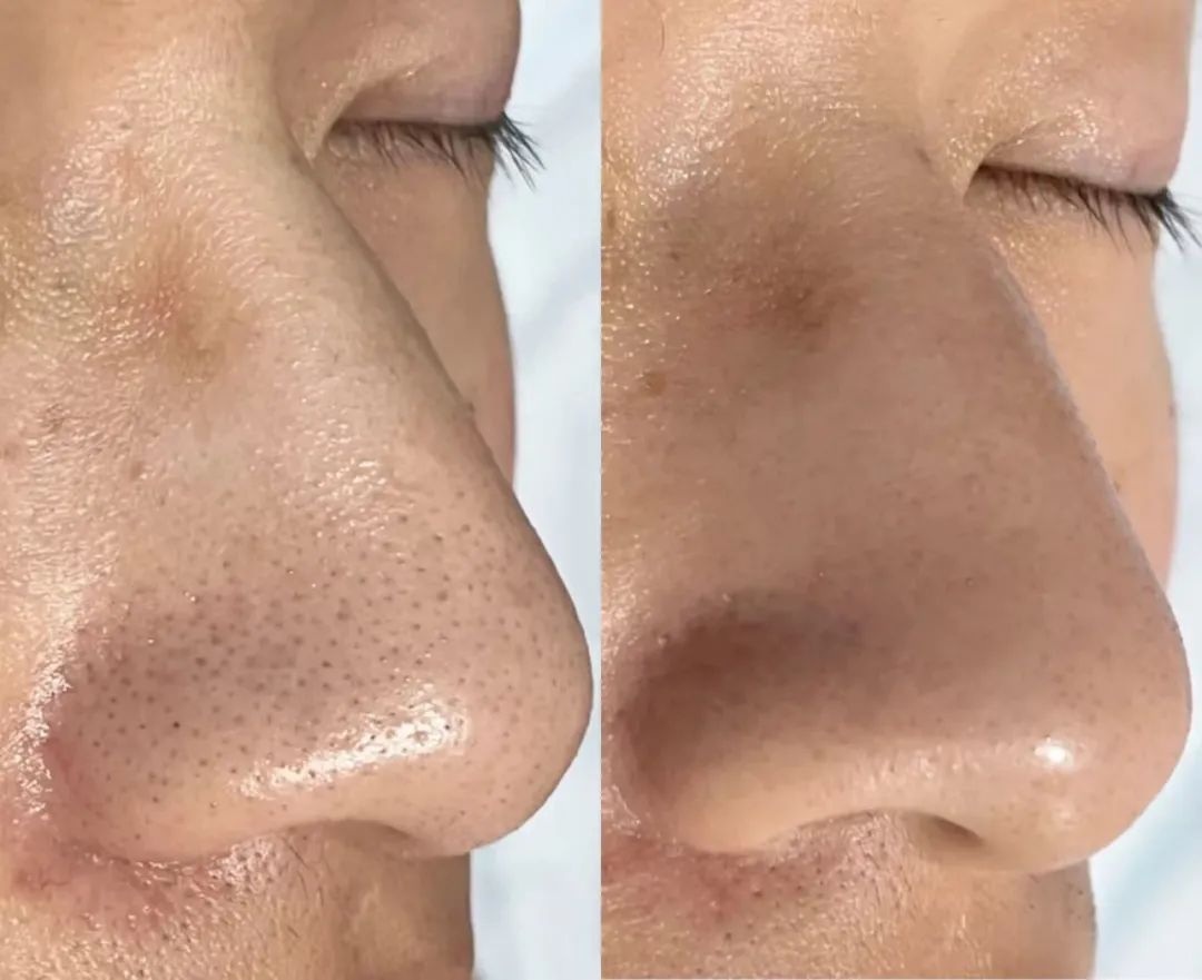 轻松搞掉草莓鼻,超方便~△全称:hfp 乳糖酸去黑头鼻贴还原美容院去