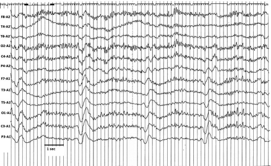 秒为一个间期的弥漫性,双侧同步性,周期性的高波幅双相和三相 δ 波