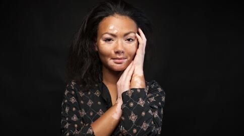 深圳肤康皮肤病专科春季皮肤缺水干燥对白癜风恢复有影响吗