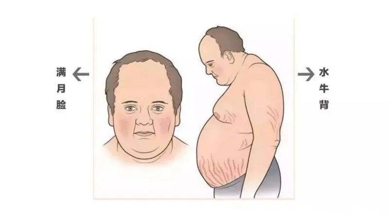 满月脸水牛背还蛙腹小心肾上腺皮质功能亢进症
