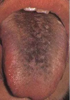 舌头一旦出现这个信号马上去医院千万别拖