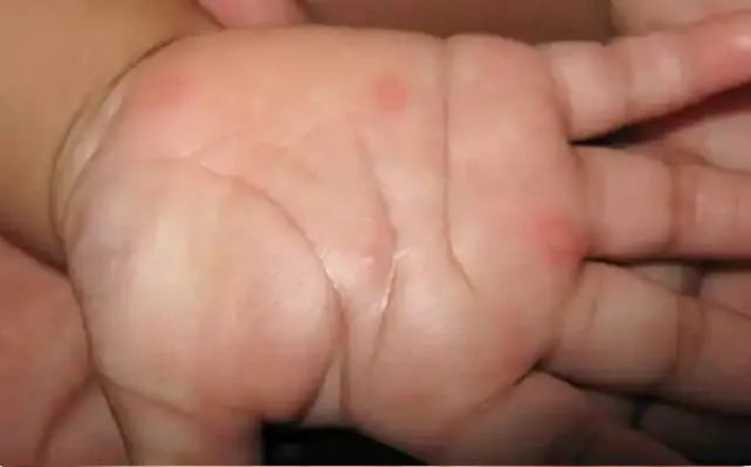 继不明原因儿童肝炎后，又一罕见疾病暴发，致死率极高！休闲区蓝鸢梦想 - Www.slyday.coM