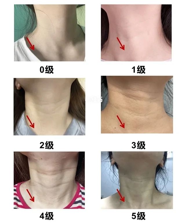 老不老看脖子快来对照你的颈纹是几级
