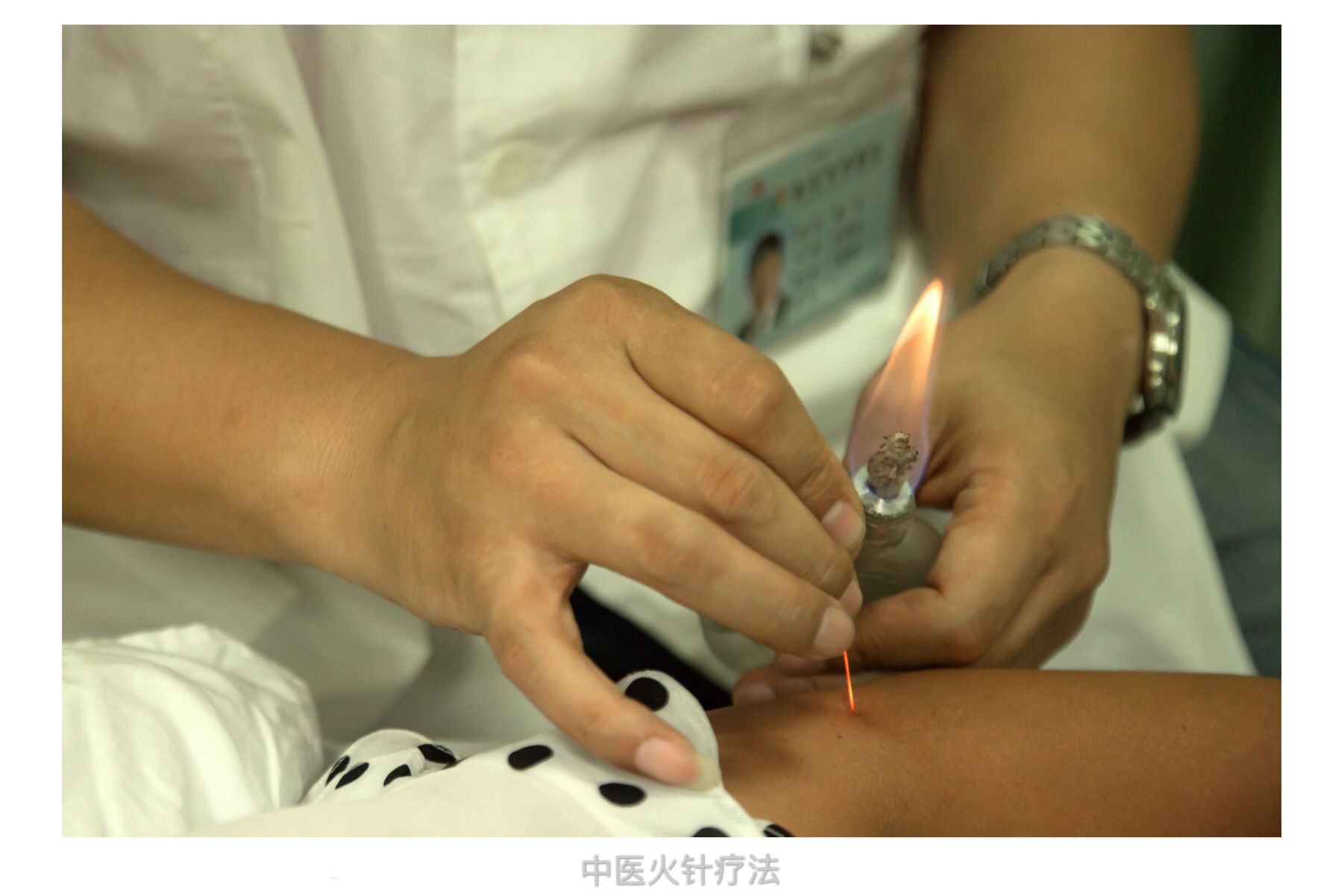 疮口久久不愈 火针祛瘀生新__财经头条