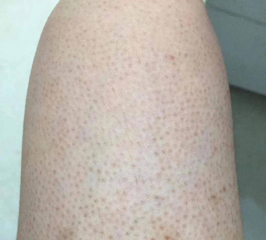 在于毛囊皮脂腺开口处即毛孔周围角质代谢异常,堆积的角质形成"角栓"