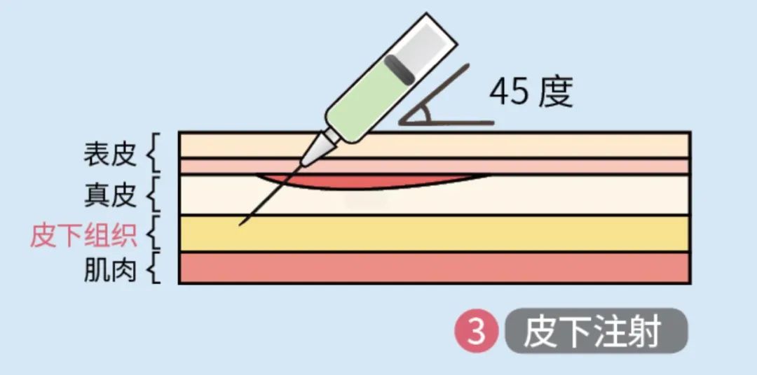 皮下注射时,针头以45度角插入皮下组织.