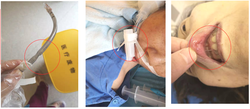 为此,郏丽萍设计了一款防气管插管病人牙齿损坏和牙垫压疮的球形口腔