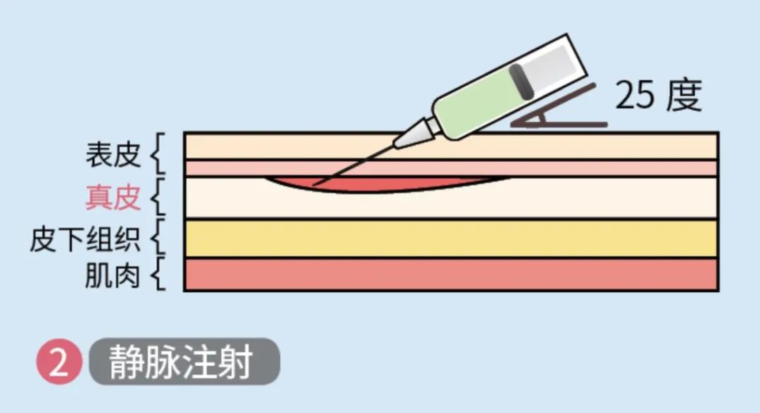 静脉注射将针头以25度角插入血管内.输液,体检抽血都是用这种方式.