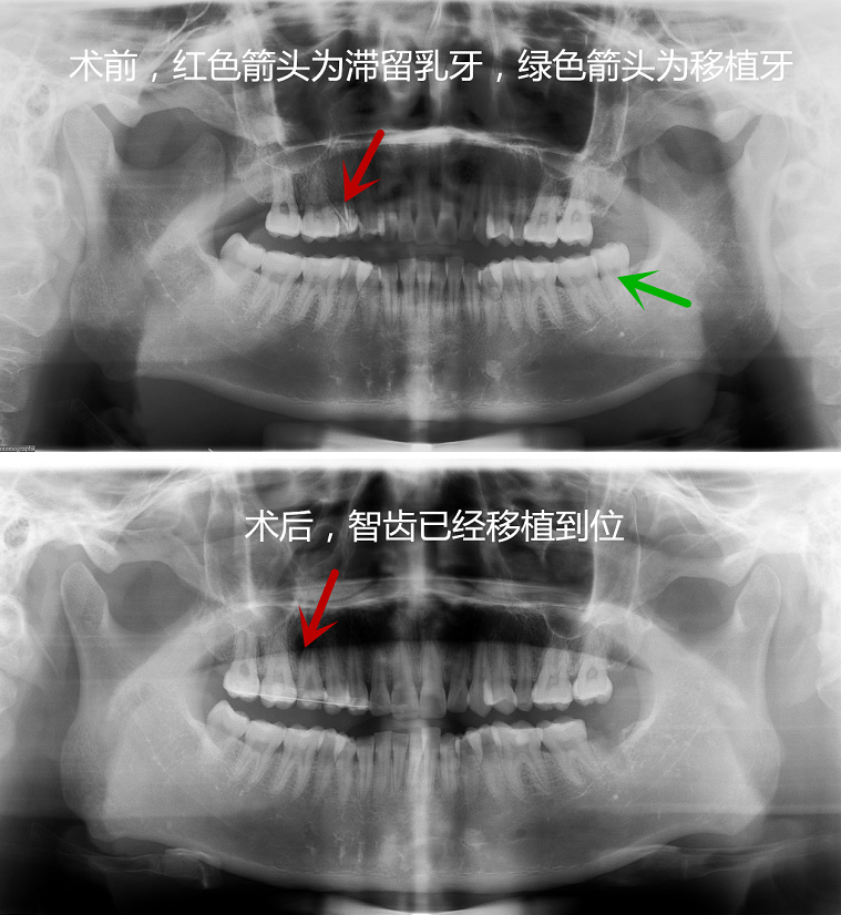 智齿该不该拔 智齿拔除需注意哪些方面