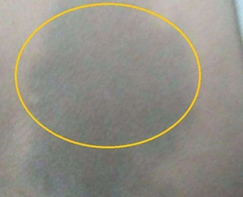 新生儿身上的“淤青”，是在产道中被挤压的，还是被医生拍的？休闲区蓝鸢梦想 - Www.slyday.coM