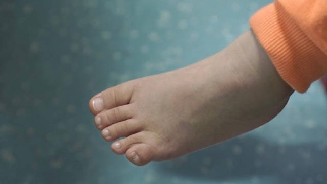 这是一个多趾伴并趾的孩子,妈妈带着非常多的问题来了门诊