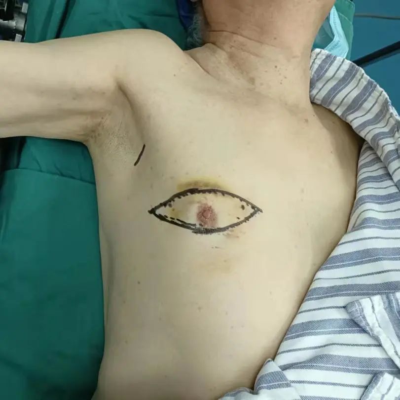 74岁老伯胸部惊现硬疙瘩74岁的李伯伯(化姓),6年前洗澡时,发现右侧