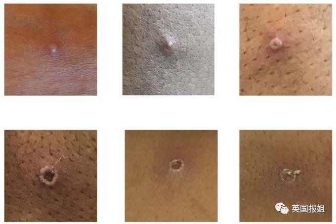 欧美11国突爆猴痘！天花近亲疑似社区传播，美专家：病毒传染变强恐威胁全球休闲区蓝鸢梦想 - Www.slyday.coM