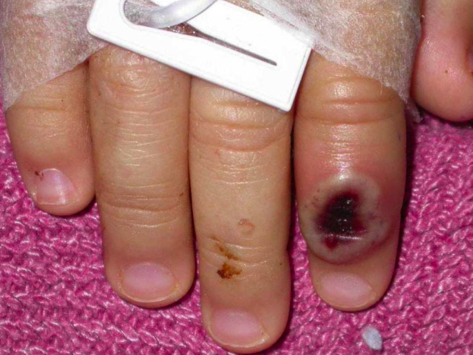 死亡率高达10猴痘病毒突然在多国爆发症状与天花极其相似