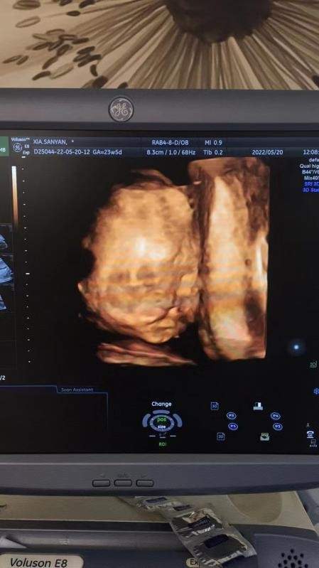 胎儿面部唇腭裂当得知这个结果后,张女士后悔不已,如今宝宝已经23周