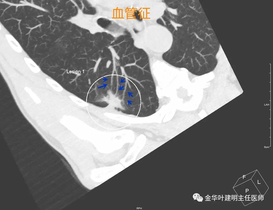 肺界限的体表投影-胸心外科解剖-医学