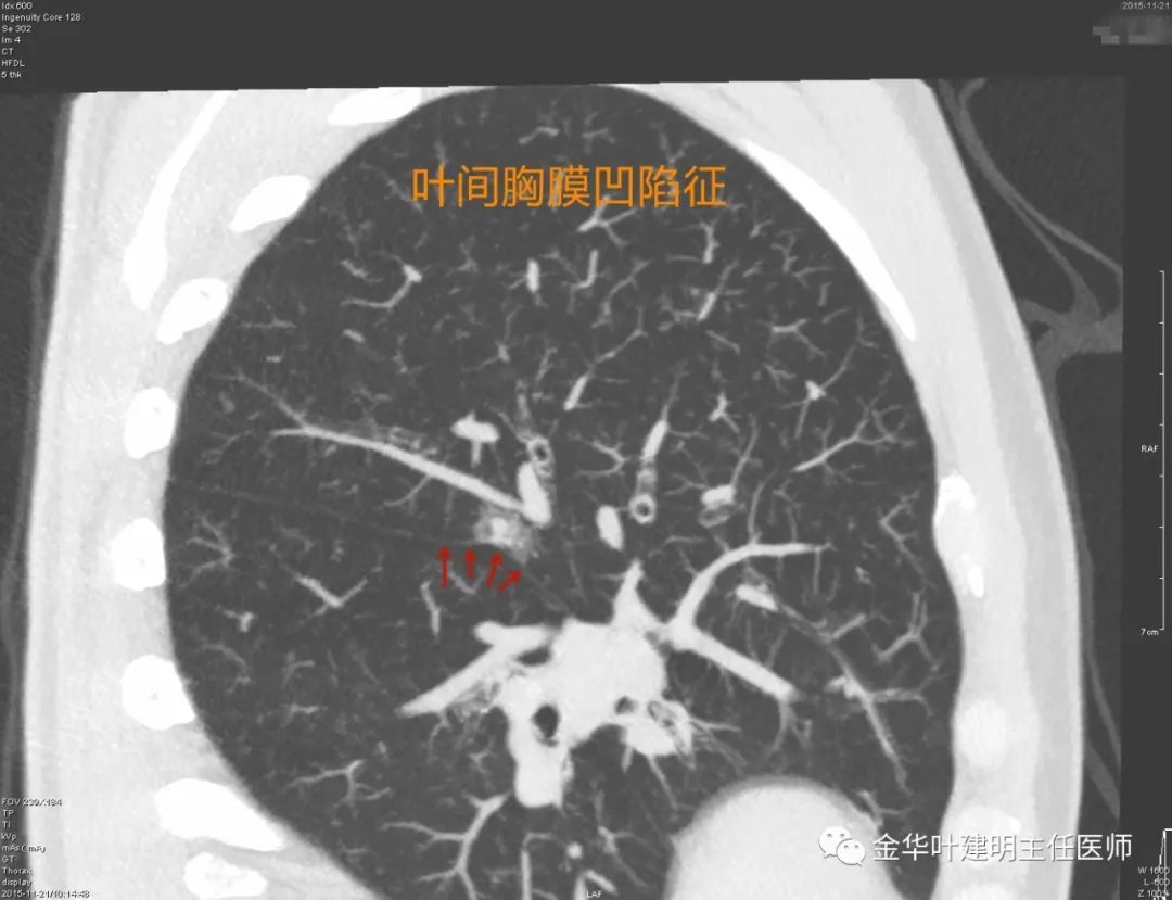 15个常见的恶性肺结节影像特征 | 建议收藏|肺癌|病灶|胸膜_新浪新闻