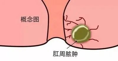 久痔不愈别把肛周脓肿当痔疮