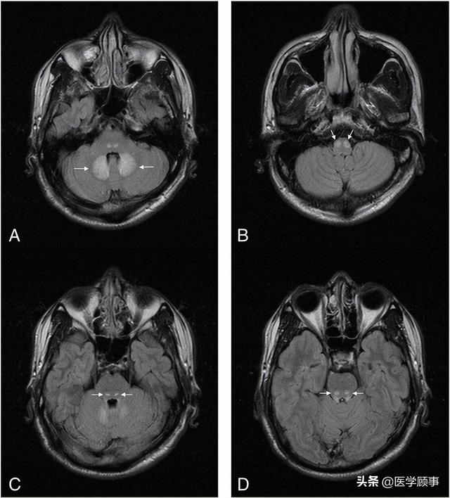 wernicke脑病的影像特点