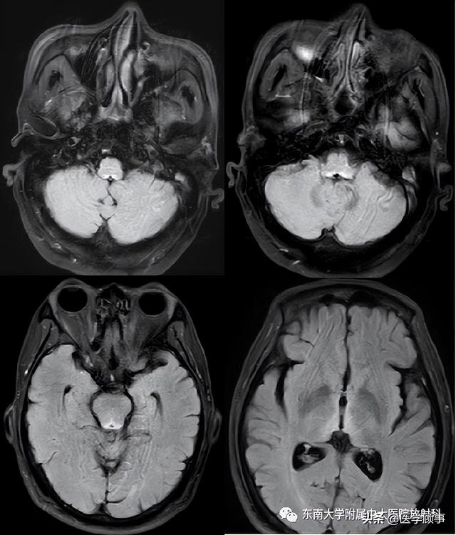 wernicke脑病的影像特点