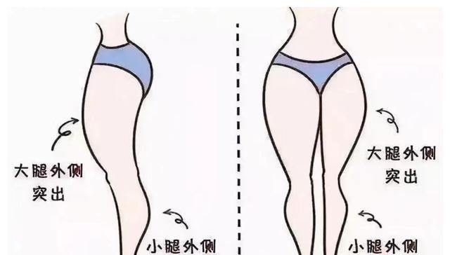 肌肉牵拉向前,引起髋关节过度内旋,造成髋部外凸,大腿外翻