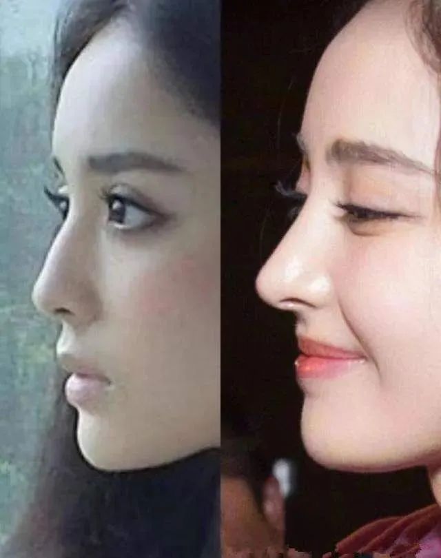 从侧面来看,娜扎原生鼻子弧度适中,而现在变翘变尖了太多,还有几分