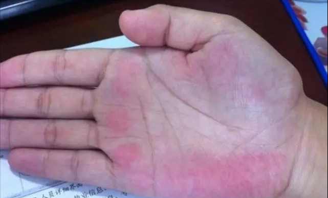 肝病的5个征兆从手掌皮肤脸色就能看出肝脏问题