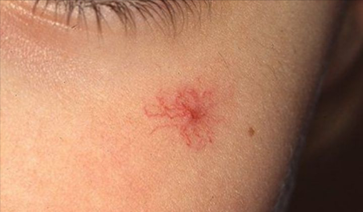 信号3:蛙腹当肝病发展至进入肝功能失代偿期,症状加重,常有体重减轻